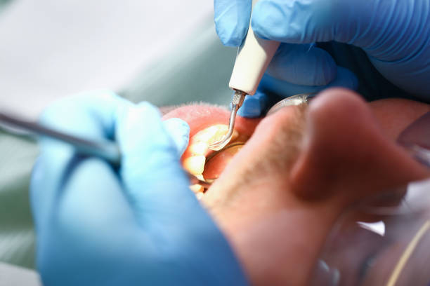 Best Teeth Whitening  in Montesano, WA
