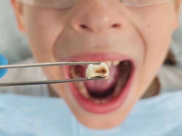 Emergency Dental Filling Replacement in WA